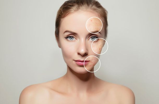 melasma pigmentaciones o paño en el postparto